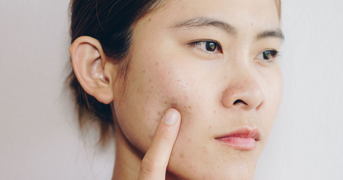 Acne on cheeks: the expert-led guide to managing it