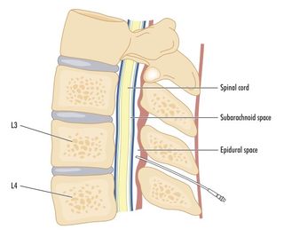 This cross section of the spinal cord shows where the epidural catheter goes.