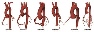 Patient-specific aorta