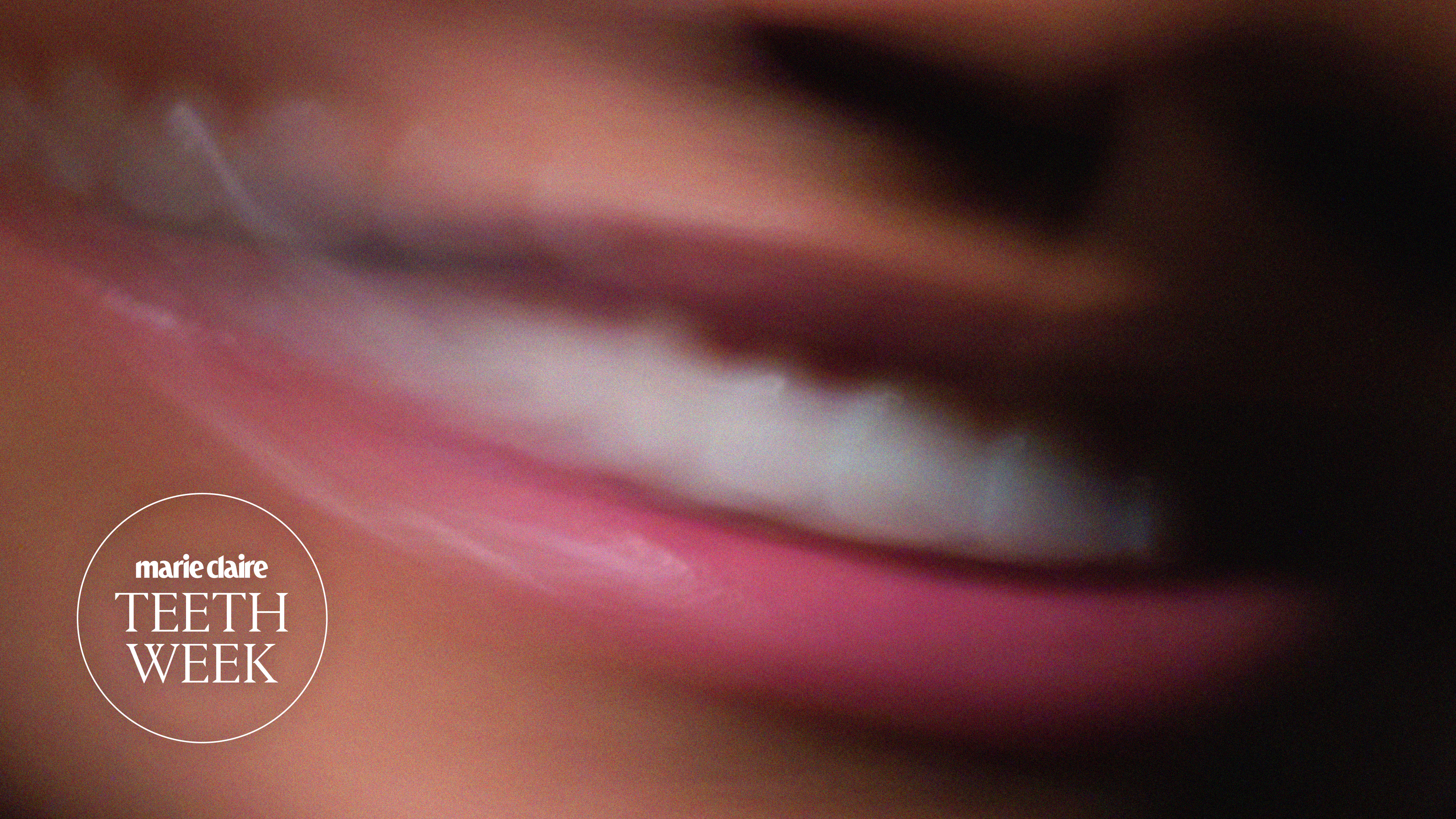 Veneers