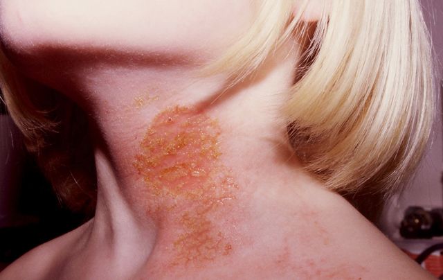 impetigo-what-are-the-symptoms-signs-and-treatment-goodto