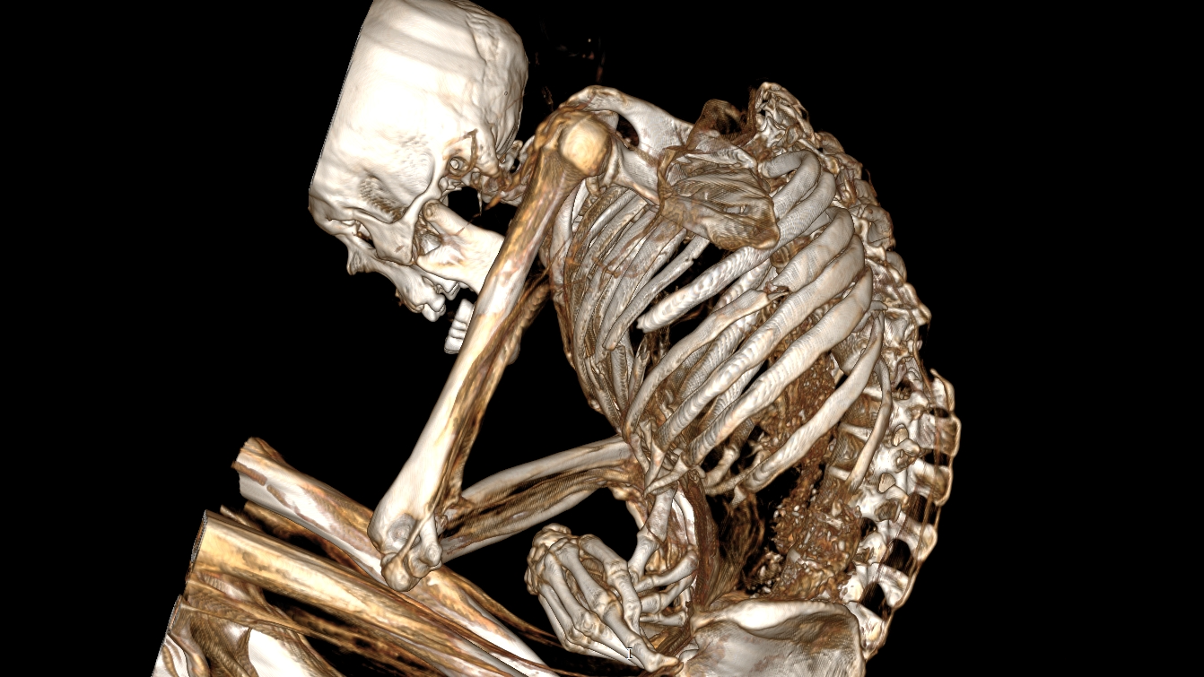 CT scan of a human mummy revealing bones