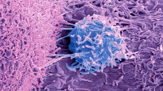 microscopic image shows a prostate cancer cell, depicted in purplish blue, against a pink background of other cells