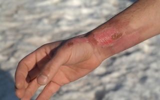 blisters, hives