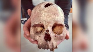A skull dated to the Bronze Age with a hole in its cranium from trepanation.