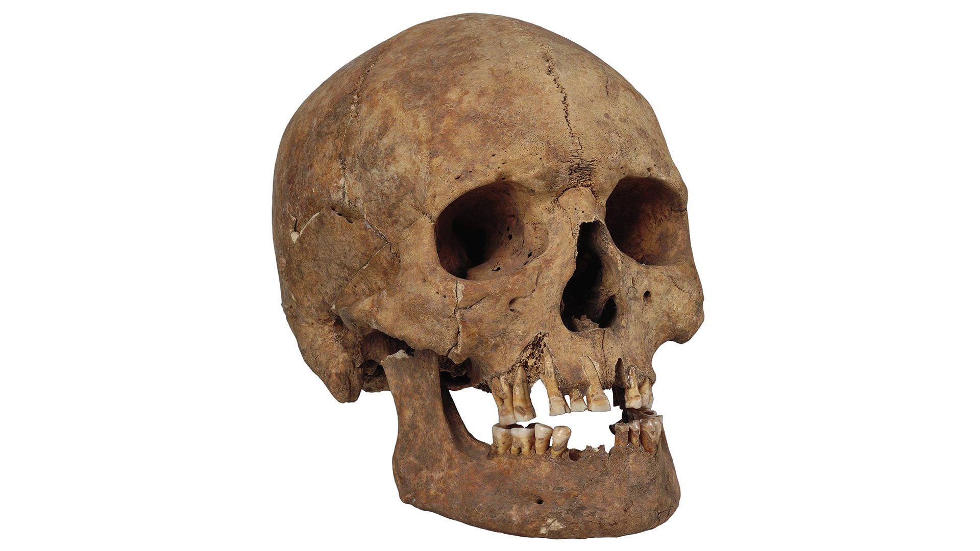 The skull of a man with filed teeth who was buried on Gotland during the Viking Age.