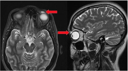 bmj case report, brain scan