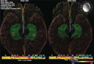 Genes in the brain associated with hippocampus size and intelligence.