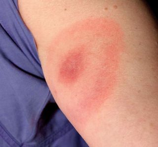 lyme disease, rash, ticks