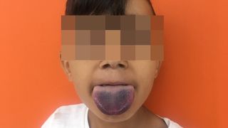  When a 7-year-old boy in Germany got his tongue stuck in the neck of a juice bottle, doctors used an ingenious method to get it out. Above, a photo of the boy after his tongue was freed from the bottle. His tongue was "lividly discolored" for several days due to damage to the tongue's capillaries.