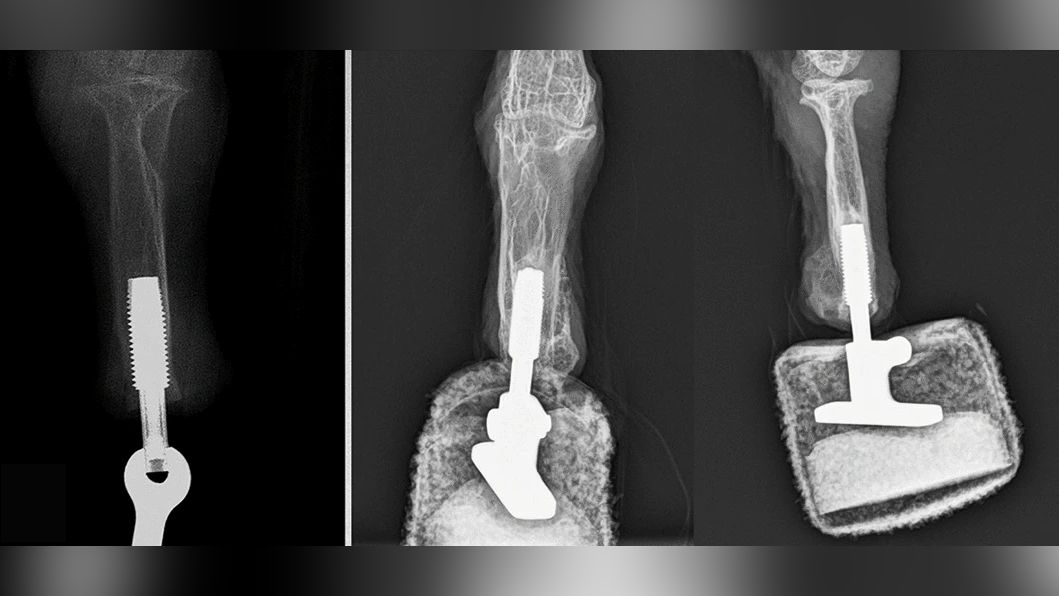 These radiographs show the implant during surgery (left) and after the surgery with the mounted prosthesis (right).