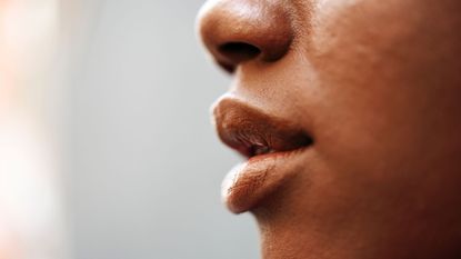 Perioral dermatitis - close up of woman's mouth and nose