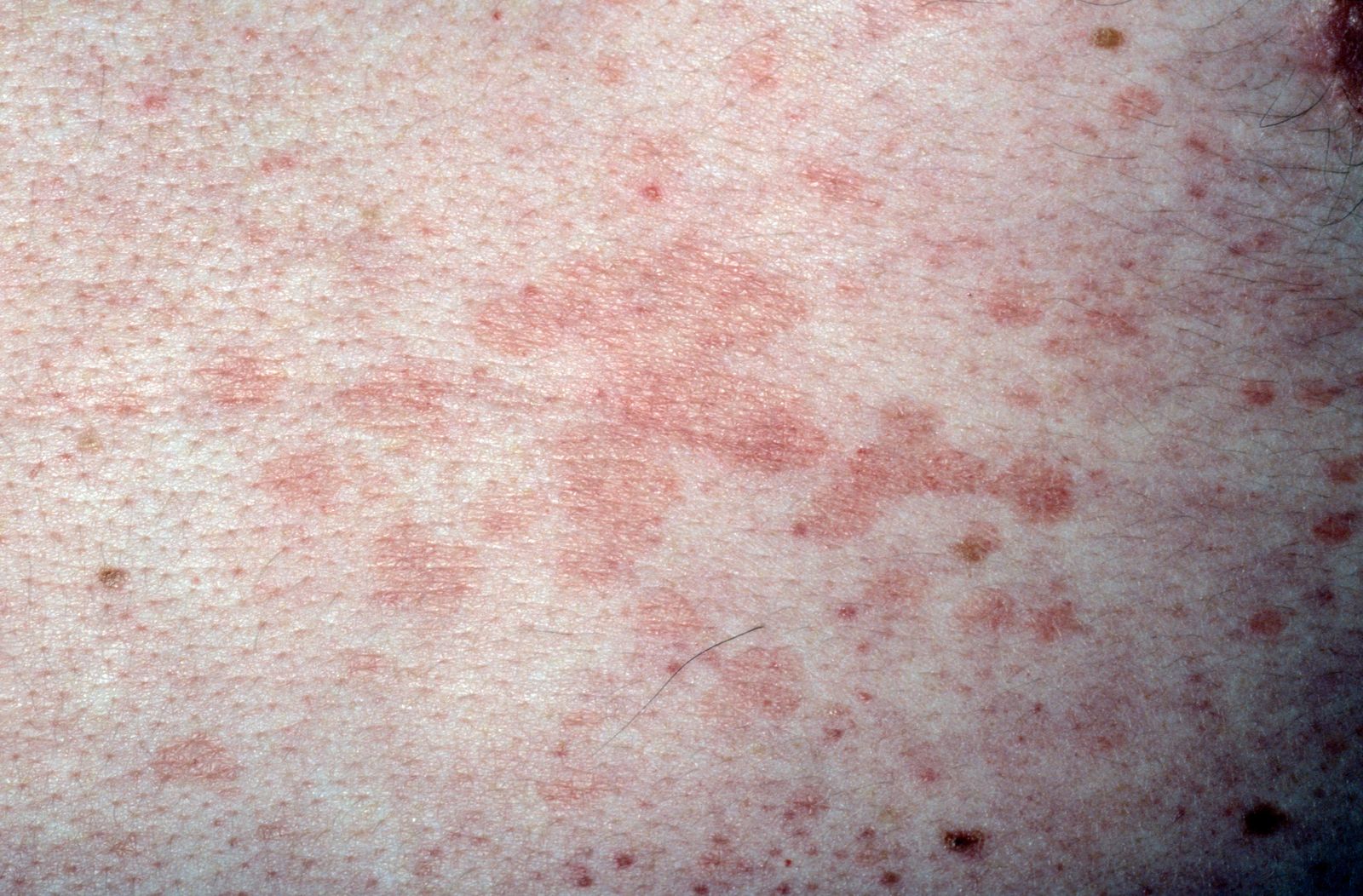 These Five Skin Conditions Have Been Linked To Coronavirus 