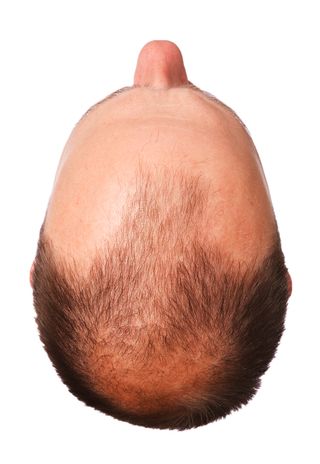 male pattern baldness