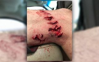 Blaine Shelton's gruesome shark bite wound, which wound up becoming infected with flesh-eating bacteria that was in the seawater.