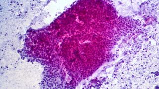 Microscope image of an adenocarcinoma in the pancreas. Cancer cells can be seen in dark pink and purple concentrated in a blob in the center of the image. Normal cells can be seen in purple dotted about around it with white gaps in the image where no cells are present. 