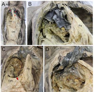 A dissection of the Korean mummy, showing the thoracic and abdominal cavities (A); the right thoracic cavity showing parts of the liver and colon (B); the defect in the diaphragm indicating congenital hernia (arrow) (C); and the liver protruding through t