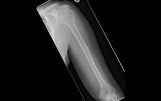 The initial X-ray of the woman's left arm, taken when she first reported increasing pain in her left arm and shoulder. This X-ray was taken before her bones showed noticeable signs of "vanishing."