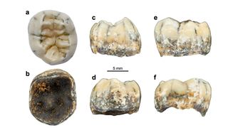 Different views of the young girl's tooth.
