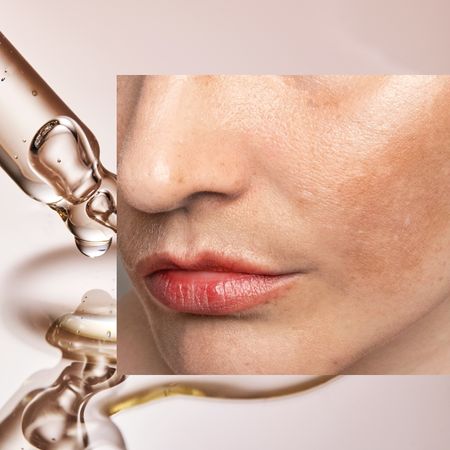 a close up of a white woman's skin with melasma on top of a background of a clear bottle dropper full of clear serum