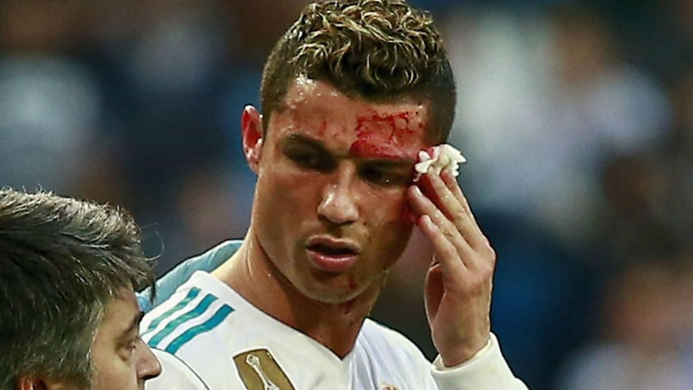 Cristiano Ronaldo takes the cameraman to the hospital, his shot causes a  hematoma on his head - Sport