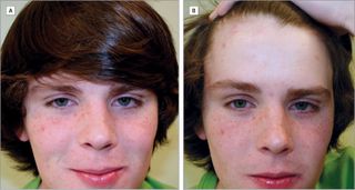 A teen with a hairstyle similar to that of celebrity Justin Bieber shows how the skin typically covered by bangs has less sun damage than the skin on the cheeks and face. Doctors say that this hairstyle can be used to teach kids about the skin damage that occurs when they don't cover up in the sun.