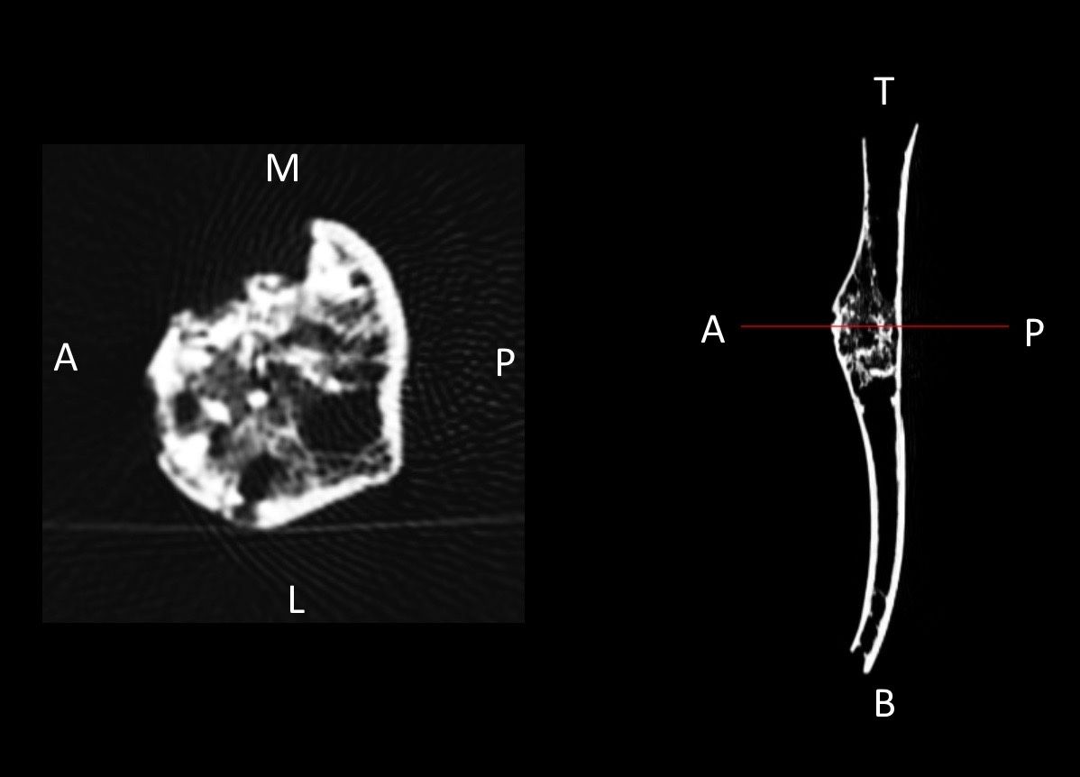 This computed tomography (CT) scan shows the right humerus of a teenage girl who died 700 years ago. The left image shows a horizontal slice through the cancerous lesion in the girl&#039;s arm.