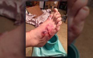 Michael Dumas' foot on July 25. Dumas contracted hookworms from sand at a Florida beach, according to his mother Kelli Dumas.