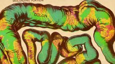 Illustrative collage of a vintage diagram of the bowels and colon, overlaid with a macro photograph of colon cancer cells.