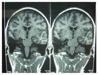 An MRI scan of the brain shows parts of the temporal lobe and amygdala are removed from one hemisphere.