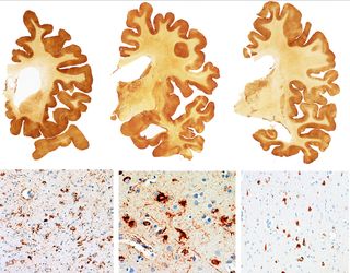 These images show severe CTE in the brain. The brown stain reveals the presence of a protein called tau.