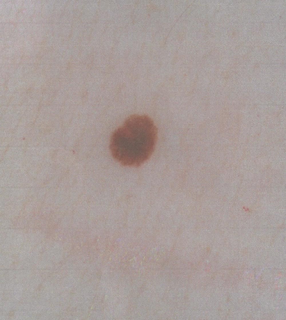 melanoma, skin cancer, moles