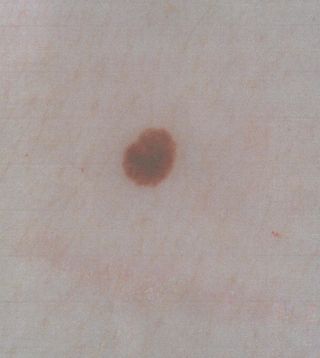 melanoma, skin cancer, moles