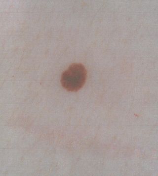 skin cancer