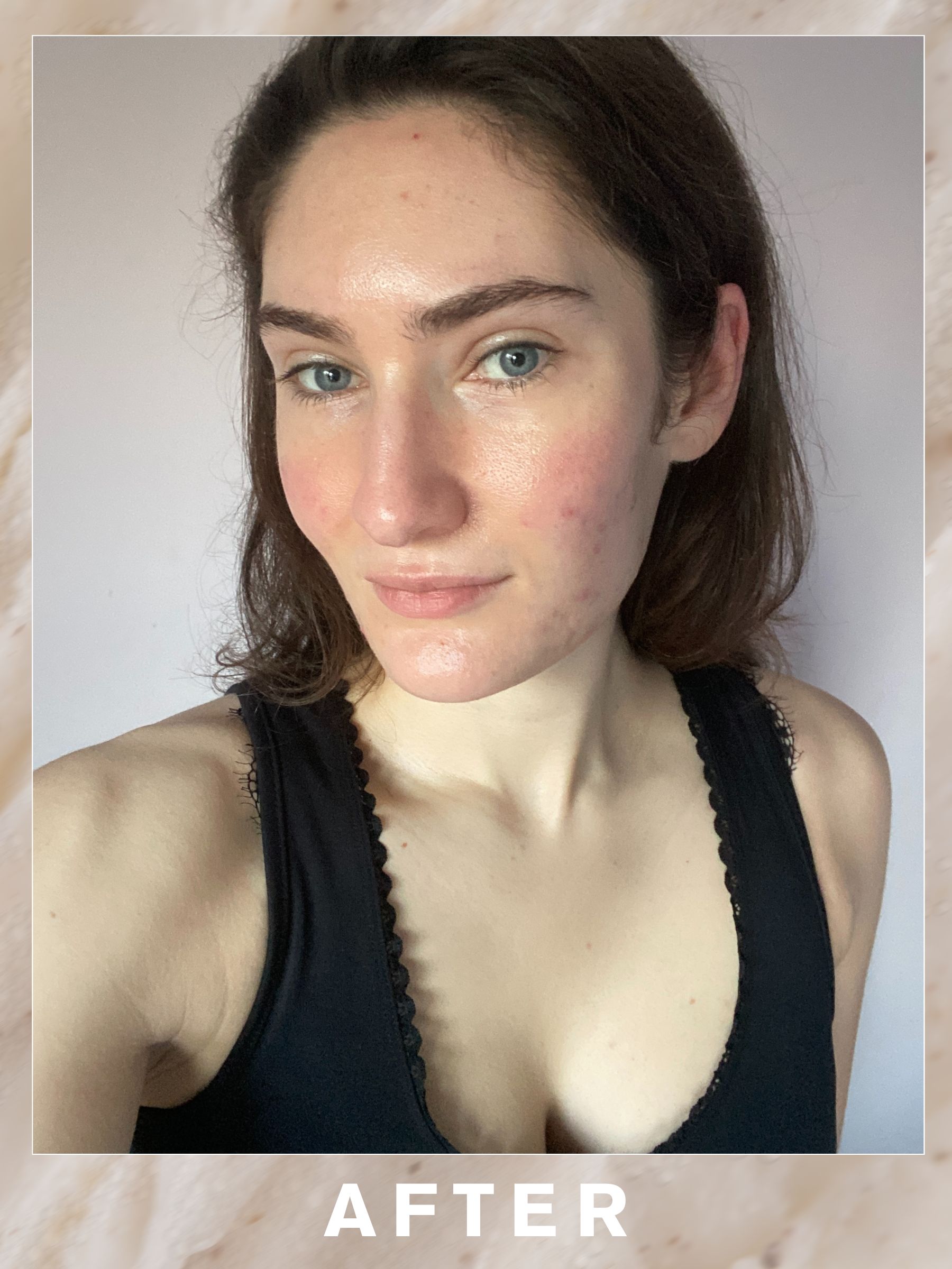 Natalie after her Dr Barbara Sturm Adult Acne Facial