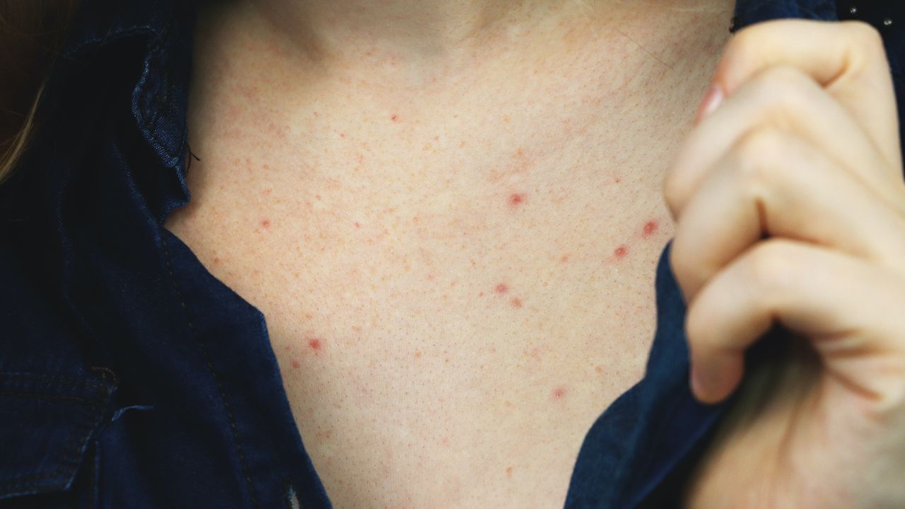 close up of woman with chest acne