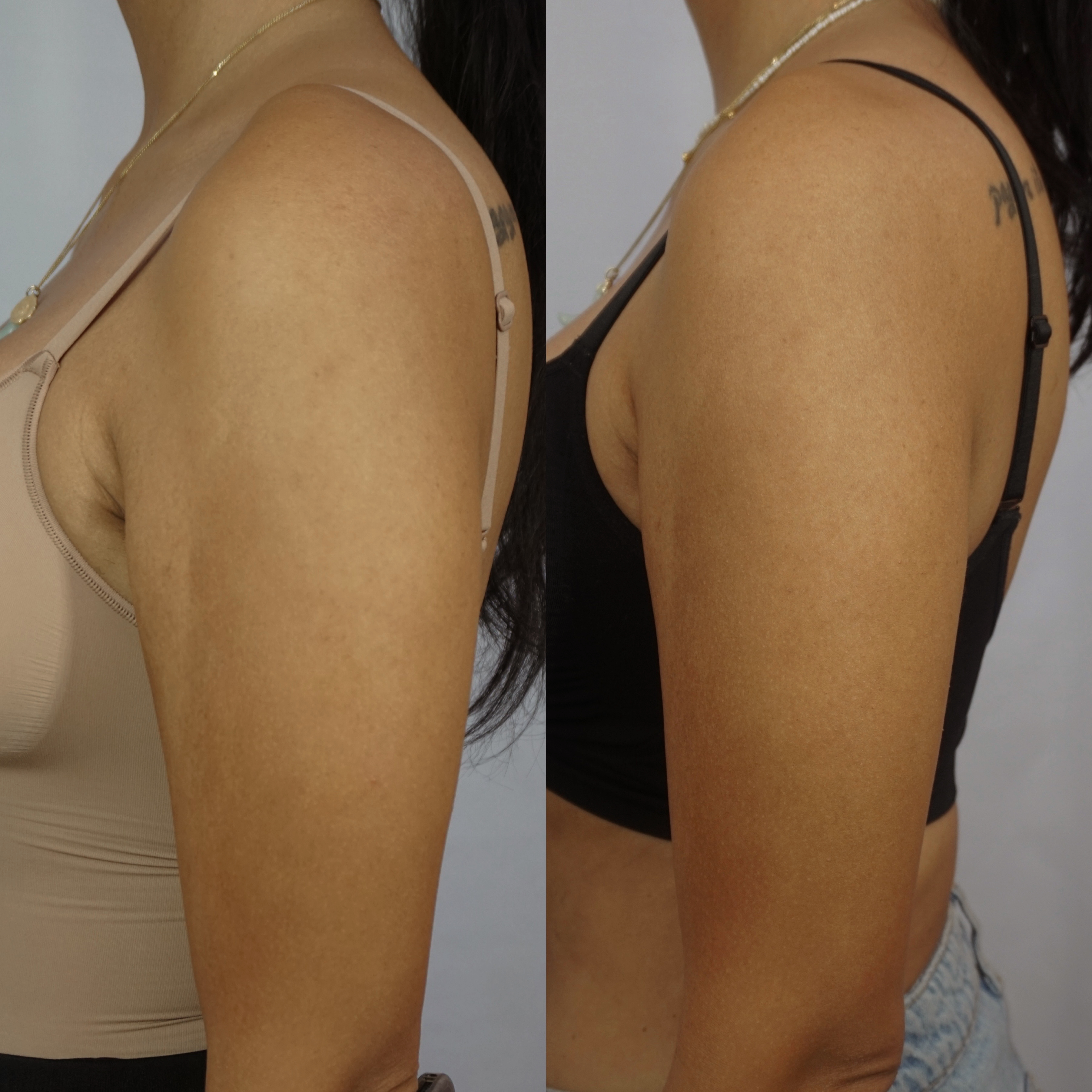 Before and after image of the arms following Onda Pro treatments.
