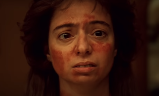 A woman with a rash all over her skin