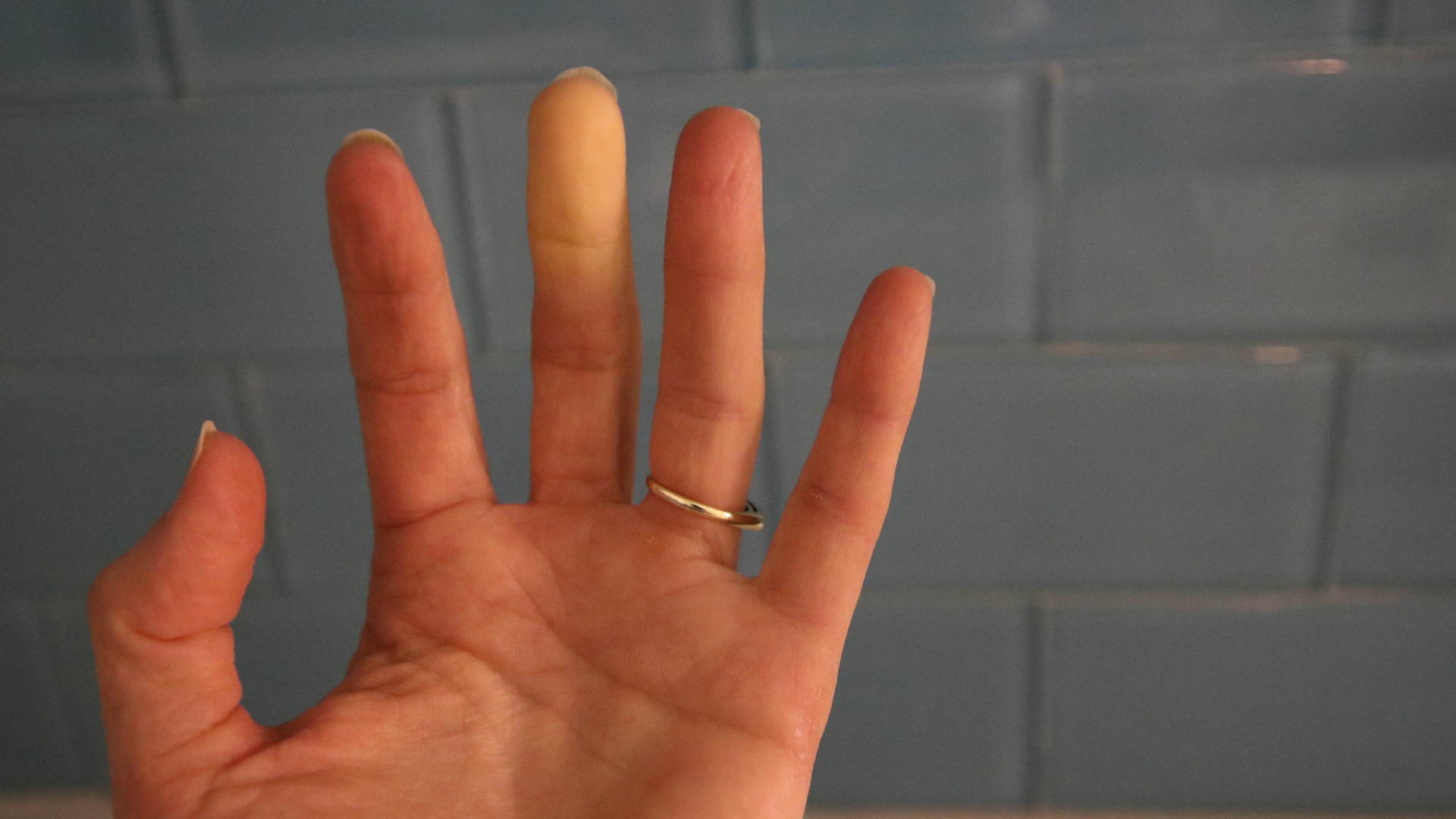 women with Raynaud's disease showing bad circulation