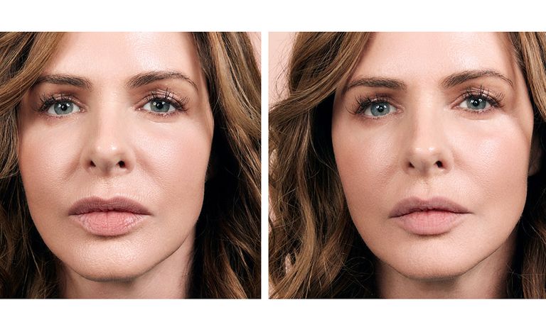 Featured - Trinny Woodall Plastic Surgery