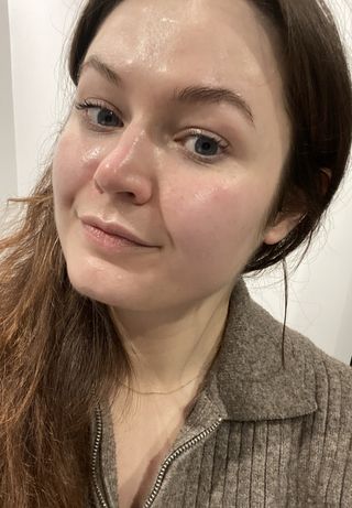 Lucy's skin after the Hydrafacial