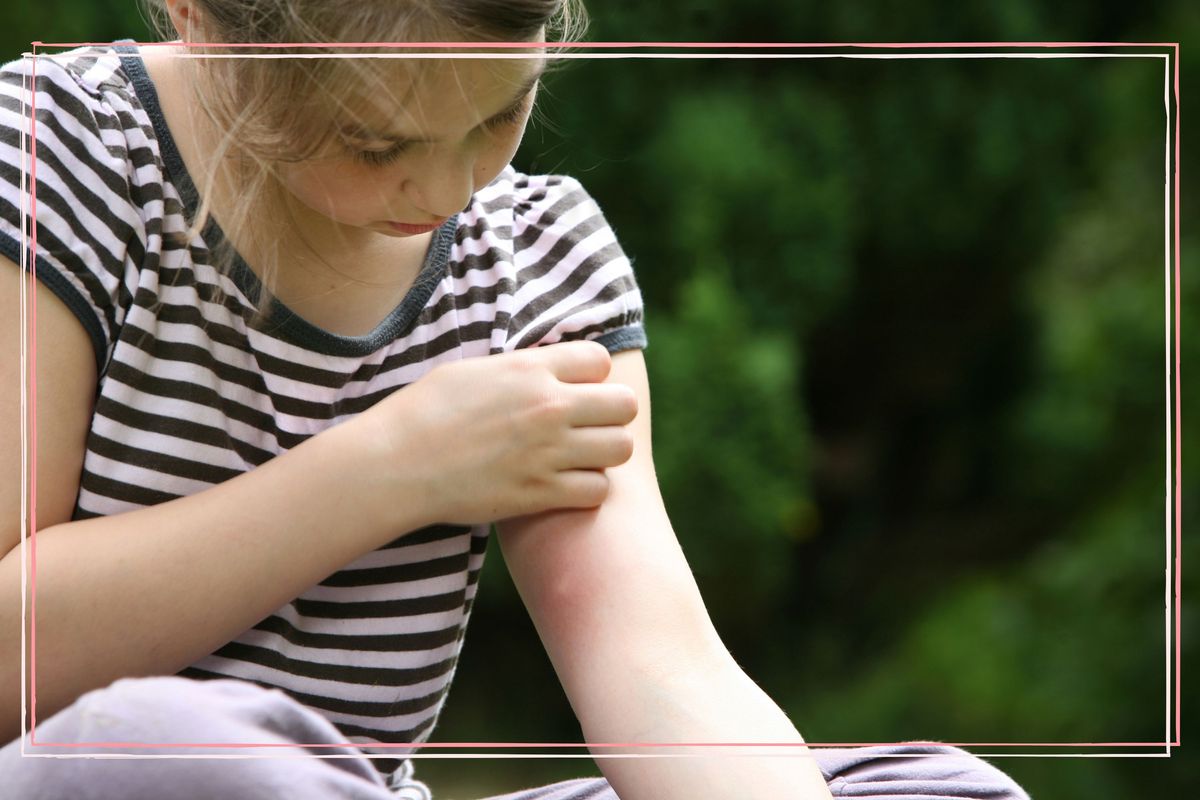 Common types of insect bites, how to treat them and stop them itching