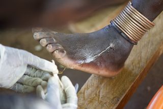 Extracting a Guinea worm is a slow and painful process. The worm is wrapped around a stick to expedite the exiting process.