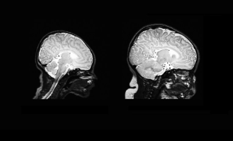 The brain scan on the left is taken from a newborn, and the one on the right is taken 90 days later.