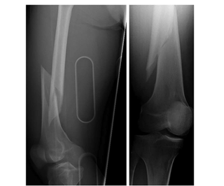 These images show the front view (right image) and side view (left image) of the patient’s broken femur bone.
