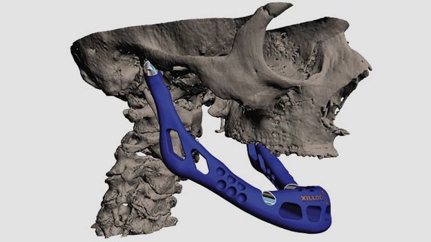Replacement Jaw