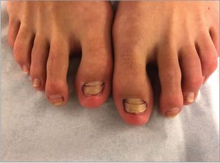 After having a "fish pedicure," a woman in New York developed a toenail condition called onychomadesis. The condition can cause deep grooves that run horizontally across the nails, or large gaps where there is no nail.