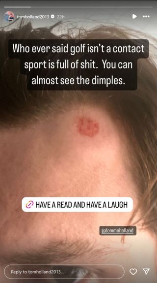 An Instagram story of Tom Holland's forehead with a red dot on it showing where he got hit in the face with a golf ball.