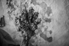 A man in Gaza with "tree man syndrome," or epidermodysplasia verruciformis, says his life has changed after undergoing surgery for the condition, which prevented him from using his hands. The condition can cause extensive, wood-like lesions on the body. A