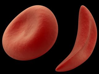 sickle-cell-100801-02